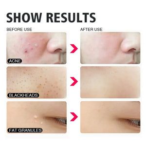 4Pcs/Set Blackhead Comedone Acne Pimple Belmish Extractor Vacuum Blackhead Remover Tool Spoon Rose Gold For Face Skin Care Tool