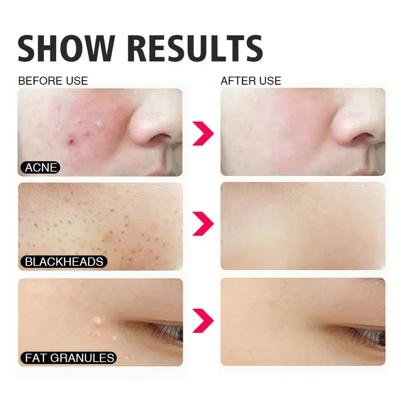 4Pcs/Set Blackhead Comedone Acne Pimple Belmish Extractor Vacuum Blackhead Remover Tool Spoon Rose Gold For Face Skin Care Tool