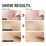 4Pcs/Set Blackhead Comedone Acne Pimple Belmish Extractor Vacuum Blackhead Remover Tool Spoon Rose Gold For Face Skin Care Tool