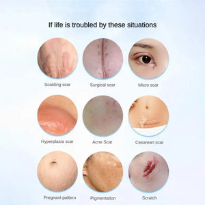Scar Removal Cream Repair Burns Scalding Surgery Stretch Marks Old Scars