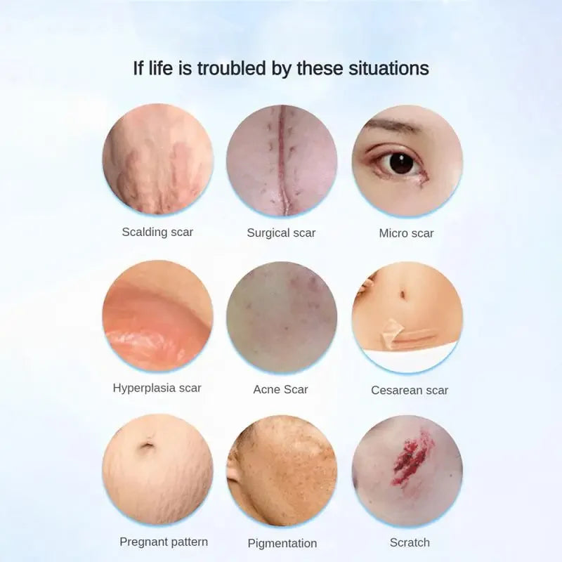Scar Removal Cream Repair Burns Scalding Surgery Stretch Marks Old Scars