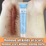 Scar Removal Cream Repair Burns Scalding Surgery Stretch Marks Old Scars
